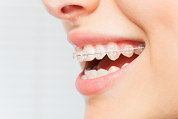 clear braces in fort wayne indiana
